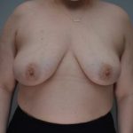 Breast Reduction Before & After Patient #1131