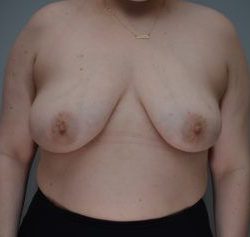 Breast Reduction Before & After Patient #1131