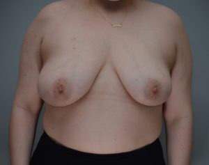 Breast Reduction Before & After Patient #1131