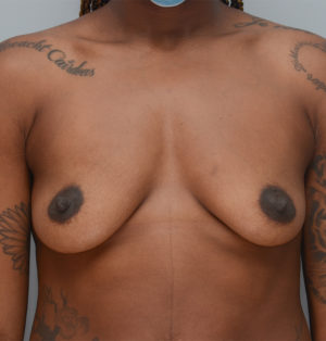 Breast Augmentation Before & After Patient #2893