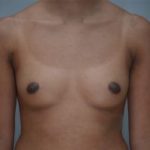 Breast Augmentation Before & After Patient #248