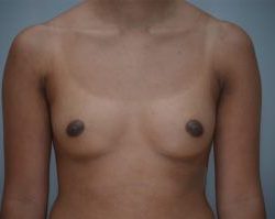 Breast Augmentation Before & After Patient #248