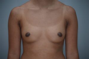 Breast Augmentation Before & After Patient #248