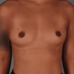 Breast Augmentation Before & After Patient #359