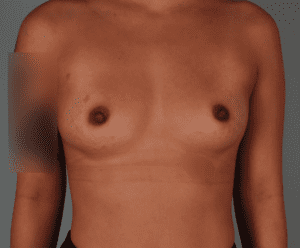 Breast Augmentation Before & After Patient #359