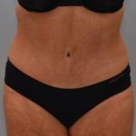 Abdominoplasty Before & After Patient #1443