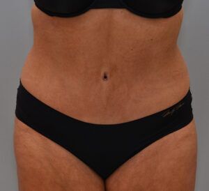 Abdominoplasty Before & After Patient #1443