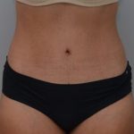 Abdominoplasty Before & After Patient #1442