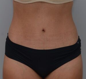 Abdominoplasty Before & After Patient #1442