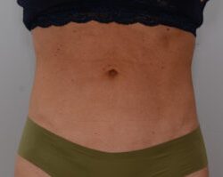 Emsculpt Neo Before & After Patient #2173
