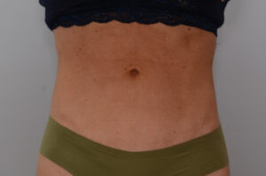 Emsculpt Neo Before & After Patient #2173