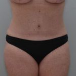 Abdominoplasty Before & After Patient #1444