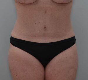 Abdominoplasty Before & After Patient #1444