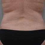 Liposuction with Bodytite Before & After Patient #1556