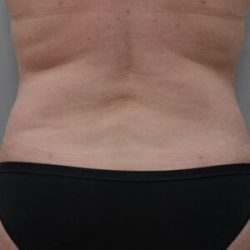 Liposuction with Bodytite Before & After Patient #1556