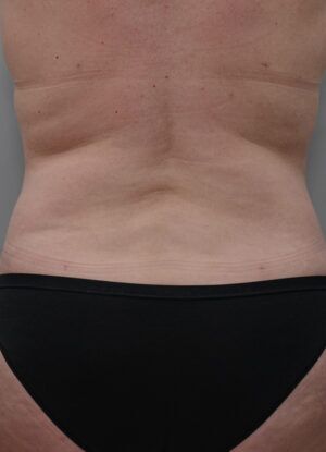 Bodytite Before & After Patient #1556