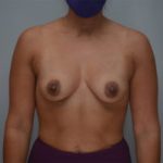 Breast Augmentation Before & After Patient #249