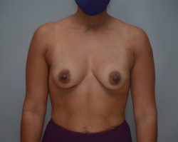 Breast Augmentation Before & After Patient #249