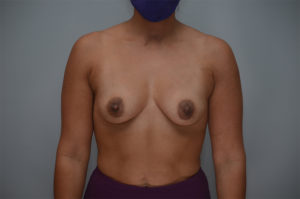 Breast Augmentation Before & After Patient #249