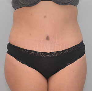 Abdominoplasty Before & After Patient #1273