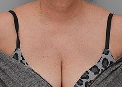 Laser Skin Resurfacing Before & After Patient #2231