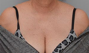 Laser Skin Resurfacing Before & After Patient #2231