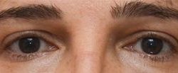 Blepharoplasty Before & After Patient #1702