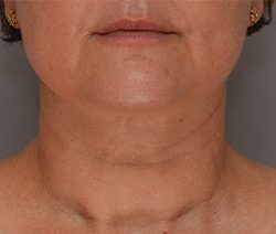 Facetite Before & After Patient #1880