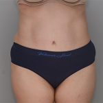 Abdominoplasty Before & After Patient #1383