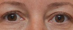 Blepharoplasty Before & After Patient #1701