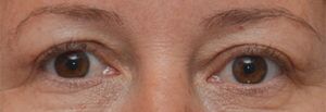 Blepharoplasty Before & After Patient #1701