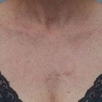 Laser Skin Resurfacing Before & After Patient #2229