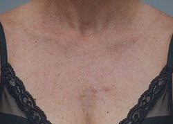Laser Skin Resurfacing Before & After Patient #2229