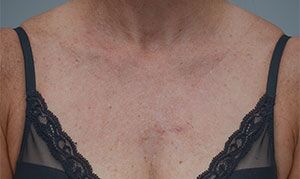 Laser Skin Resurfacing Before & After Patient #2229