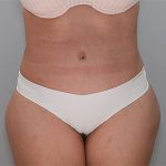 Abdominoplasty Before & After Patient #1329
