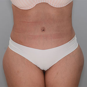 Abdominoplasty Before & After Patient #1329