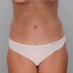 Abdominoplasty Before & After Patient #1328