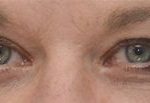 Blepharoplasty Before & After Patient #1700