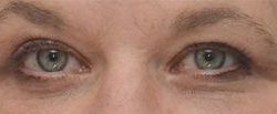 Blepharoplasty Before & After Patient #1700