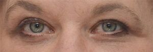 Blepharoplasty Before & After Patient #1700