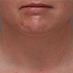 Neck Liposuction Before & After Patient #1951