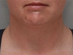 Neck Liposuction Before & After Patient #1951