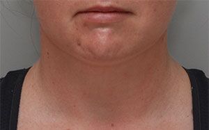 Neck Liposuction Before & After Patient #1951