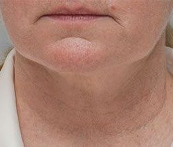 Facetite Before & After Patient #1778
