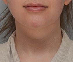 Neck Liposuction Before & After Patient #1950