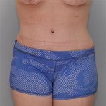 Abdominoplasty Before & After Patient #1272