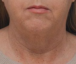 Facetite Before & After Patient #1882