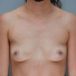Breast Augmentation Before & After Patient #250