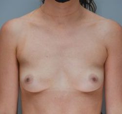 Breast Augmentation Before & After Patient #250
