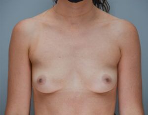 Breast Augmentation Before & After Patient #250